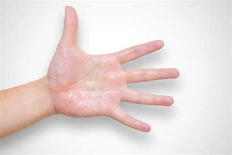 are sweaty hands generic